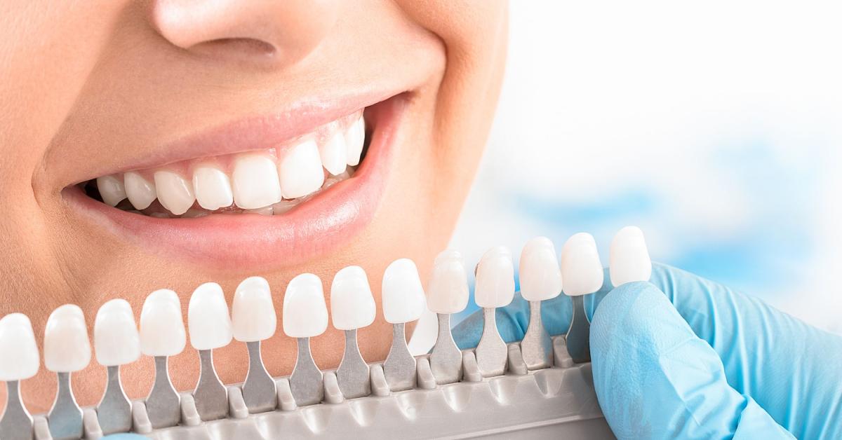 Sbiancamento Professionale. Denti più bianchi e naturali