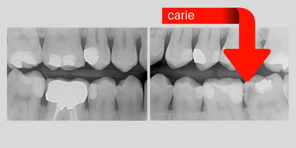 Carie Dentale Prevenire Con Un Sorriso - Clinica Villa