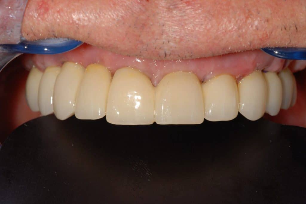 paziente trattato con impianti dentali dopo