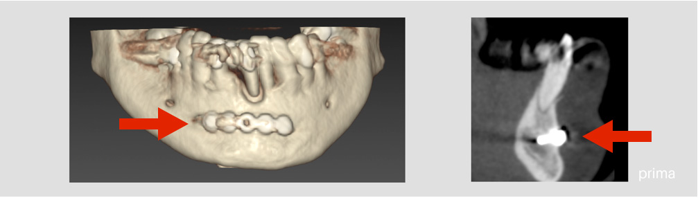 implantologia avanzata x guide pianificazione della tac della paziente