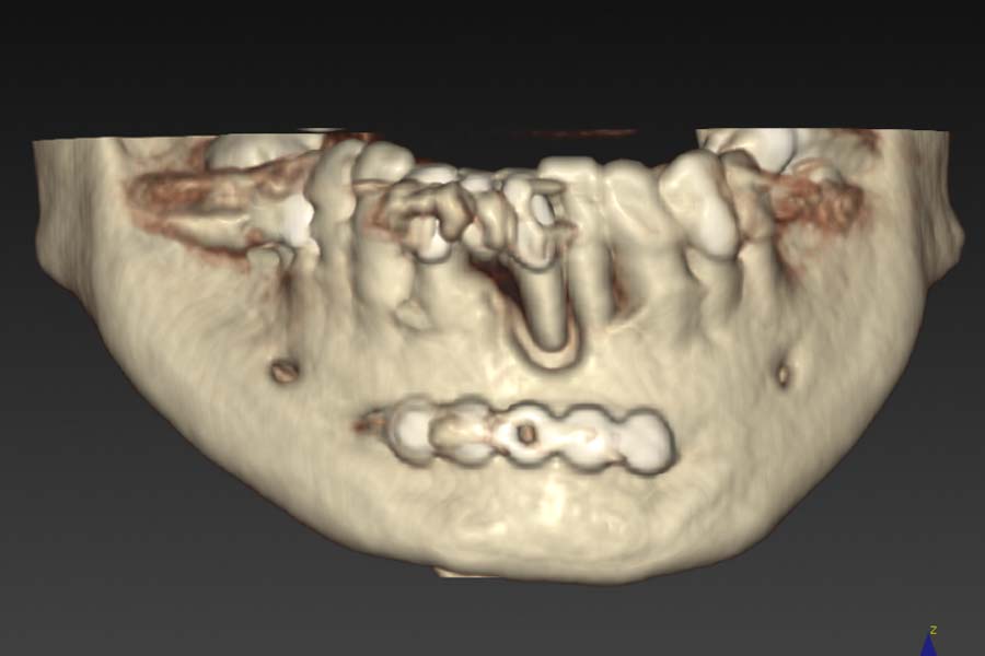 implantologia avanzata x-guide pianificazione della Tac