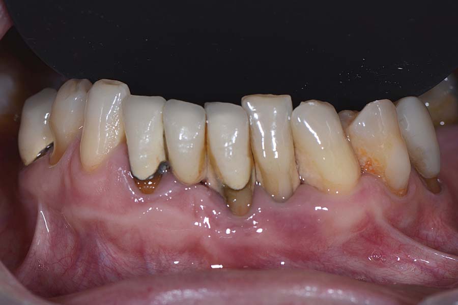 foto prima dell'intervento di implantologia x-guide. La paziente aveva una parodontite avanzata. i denti si muovevano