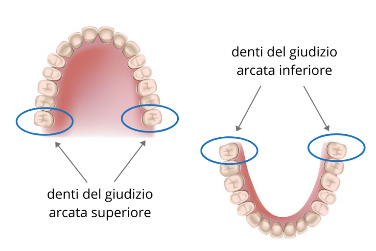 Dente del giudizio: sintomi, cura e costi - Clinica Villa